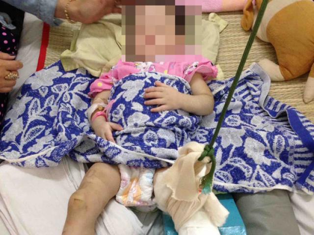 ”Mẹ nuôi” đánh bé gái 1 tuổi đến gãy chân chỉ vì biếng ăn, hay khóc