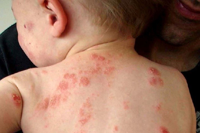 Chủ quan với vài nốt mụn, đây mới là biến chứng khôn lường - 1