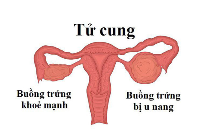 Biến chứng u nang buồng trứng có thực sự nguy hiểm? - 1