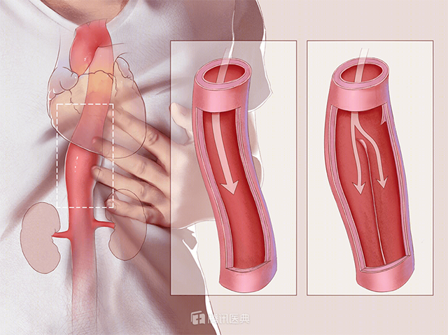 Bác sĩ cấp cứu suốt 10 tiếng người đàn ông đau bụng, thủ phạm là căn bệnh mang tên &#34;kẻ giết người lốc xoáy&#34; - 2