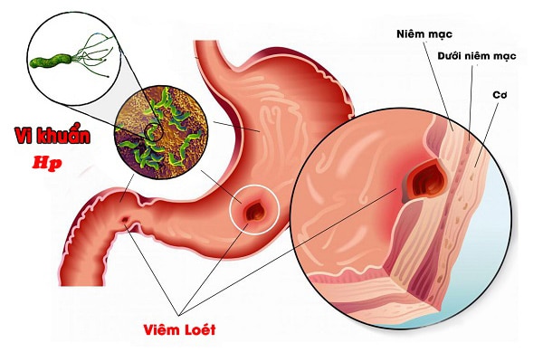 Vi khuẩn HP gây viêm loét dạ dày.