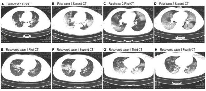 Hình ảnh CT ngực ở những bệnh nhân tử vong do nhiễm COVID-19 tại Bệnh viện Tongji ở Vũ Hán, Trung Quốc