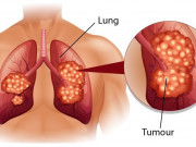 Sức khỏe đời sống - 6 biện pháp phòng ung thư phổi