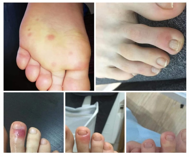 Nhiều bệnh nhân mắc&nbsp; Covid-19 thường xuất hiện các vết sưng tấy đỏ ở đàu ngón chân&nbsp;