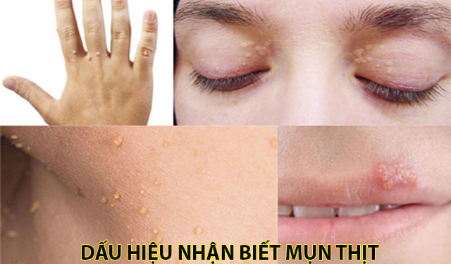 Cách trị mụn thịt quanh mắt, mặt cổ dứt điểm tận gốc tại nhà hiệu quả - 2