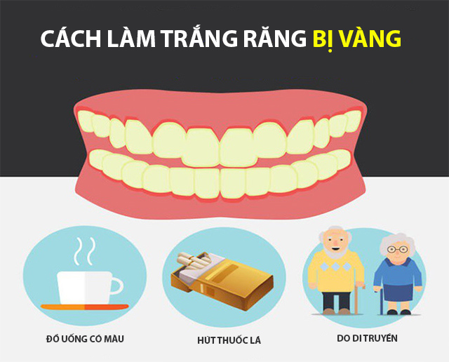 Răng Vàng Làm Sao Cho Trắng: Giải Pháp Hiệu Quả Từ Chuyên Gia