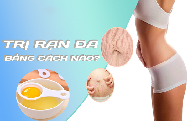 Cách trị rạn da an toàn hiệu quả nhanh nhất tại nhà - 7