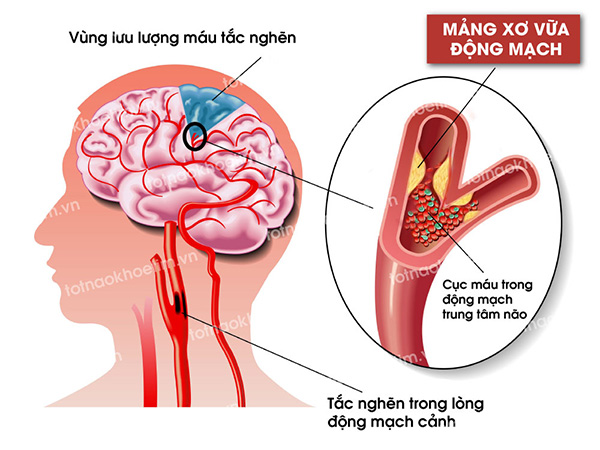 Mảng xơ vữa động mạch gây tắc nghẽn mạch máu nguy cơ tai biến mạch máu não (ảnh minh họa)