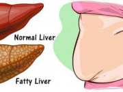 Sức khỏe đời sống - Xuất hiện 4 dấu hiệu này ai cũng chủ quan nhưng cần thải độc gan sớm, đặc biệt trong ngày hè nắng nóng