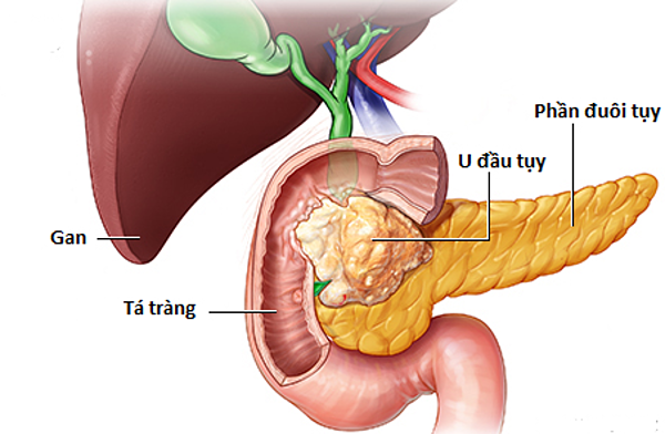 Căn bệnh khiến diễn viên &#39;Chạy án&#39; Khôi Nguyên qua đời nguy hiểm thế nào? - 2