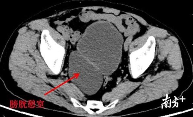 10 phút đi tiểu 1 lần, bác sĩ phát hiện bệnh nhân có thêm 1 bàng quang - 2