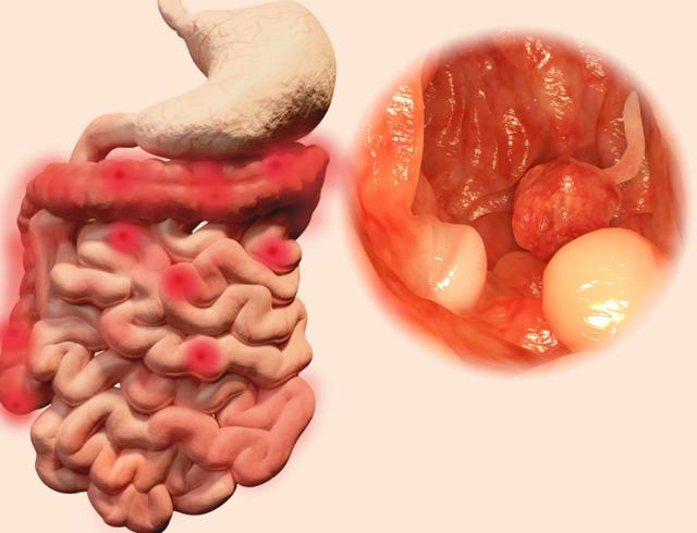 Đi vệ sinh có 3 dấu hiệu này, coi chừng ung thư ruột &#34;gõ cửa&#34; - 2