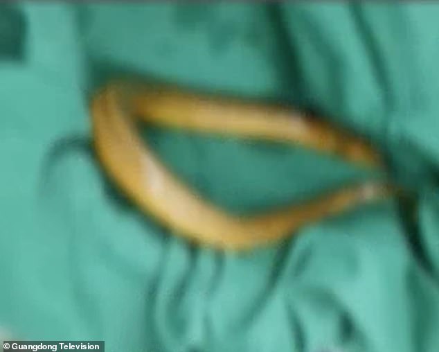 Con lươn được lấy ra khỏi cơ thể của bệnh nhân (ảnh: Daily Mail)