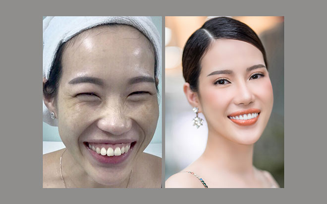 Chị Thái Ngọc là minh chứng thành công của gói “nâng cơ chỉnh hình toàn mặt – Diamond FLX Pro 2019