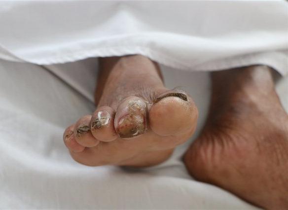 Một bệnh nhân bị vi khuẩn "ăn thịt người" ăn ngón chân - Ảnh minh hoạ