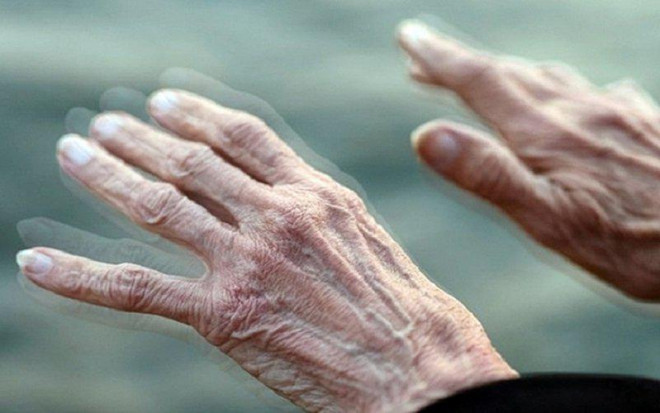 Hiện tượng run do&nbsp;mắc Parkinson thường xảy ra ở môi, ngón tay, đôi khi cả bàn tay. (Ảnh minh họa)