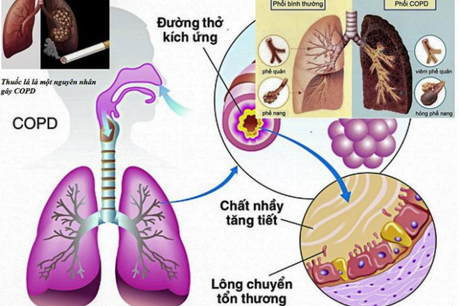 Thuốc lá - thủ phạm chính gây bệnh phổi tắc nghẽn mạn tính dẫn đến suy hô hấp.