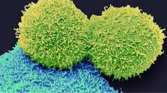 Tế bào ung thư vú (Ảnh: Science Photo Library)