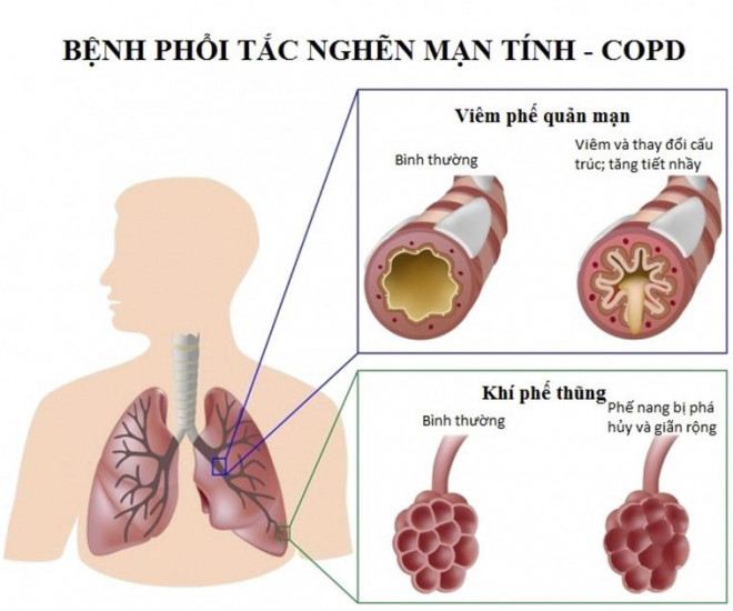 Người mắc bệnh phổi tắc nghẽn mạn tính (COPD) có nguy cơ cao mắc COVID-19.