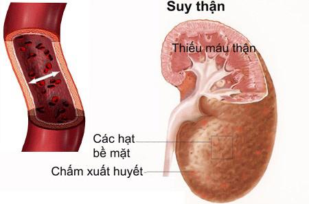 Bệnh thận mãn tính có thể làm tăng nguy cơ mắc bệnh nặng và tử vong ở những người mắc COVID-19