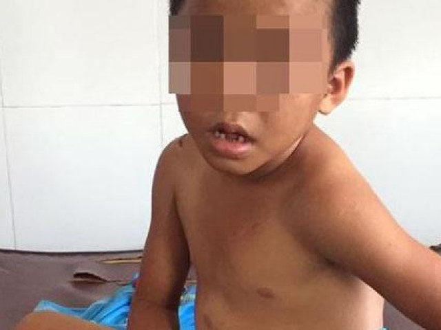 Bé trai 6 tuổi ở Sóc Trăng bị cha dượng bạo hành dã man