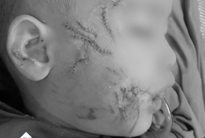 Tổn thương vùng mặt của bệnh nhi sau khi được xử trí cấp cứu - Ảnh: Bệnh viện cung cấp