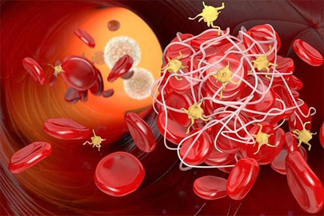 Cục máu đông - Tác nhân hàng đầu gây đột quỵ não