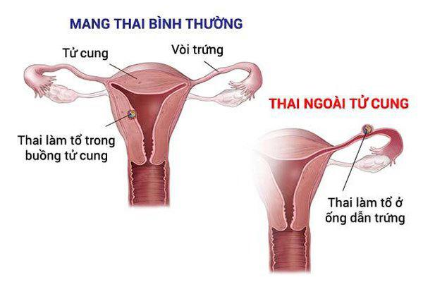 Đau bụng&nbsp;dưới trong những tuần đầu có thai có thể là dấu hiệu của thai ngoài tử cung