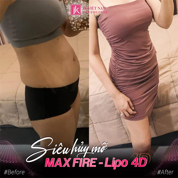 Lấy lại “vòng eo con kiến” chỉ sau 60 phút