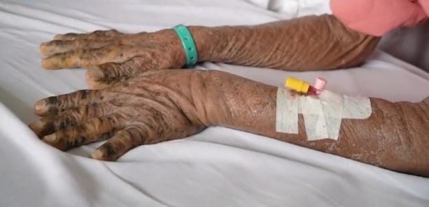 Bàn tay bất thường, sần sùi, sạm của bệnh nhân N.V.Đ bị nhiễm độc thuốc Đông y. Ảnh: BVCC