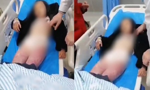 Poor score, the girl was beaten by her mother with a clothes hanger and had to be hospitalized - 1