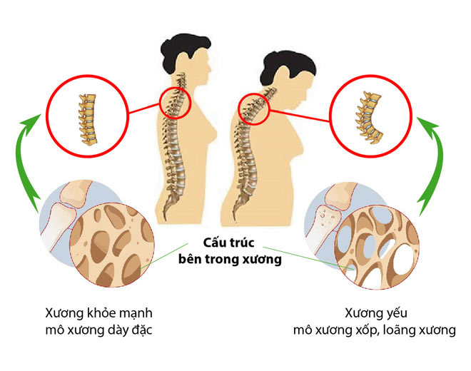 Không chỉ trẻ em, đây là 3 nhóm đối tượng cần bổ sung ngay vitamin K2 để "xương chắc, dáng cao" - 5