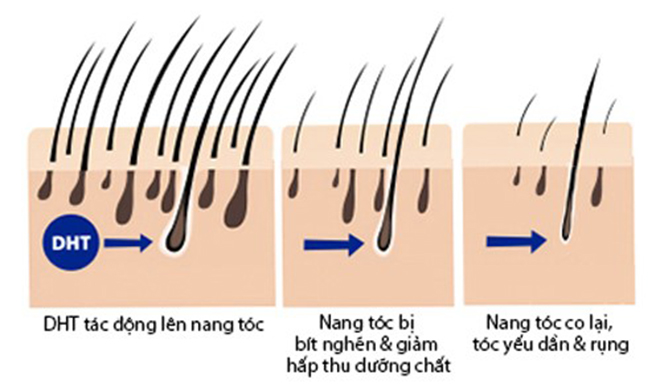 Tóc rụng nhiều, thưa bóng da đầu làm sao để tóc mọc nhanh trở lại? - 2