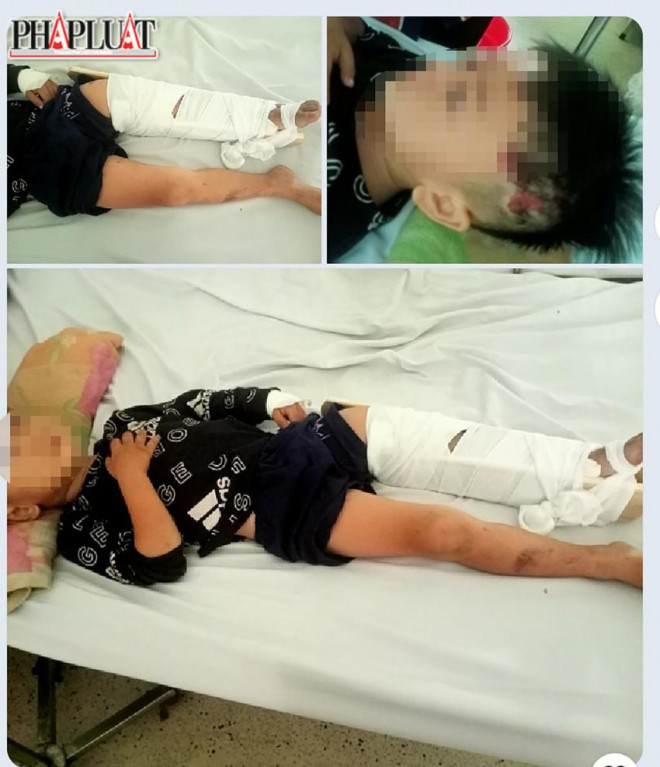 Theo gia đình, bé trai bị gãy xương chân, đầu xây xát. Ảnh: GĐCC