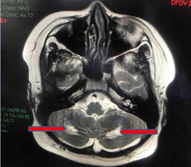 MRI não cho thấy tổn thương chất trắng vùng tiểu não 2 bên gây hiện rối loạn phối hợp vận động (ảnh: BVCC)