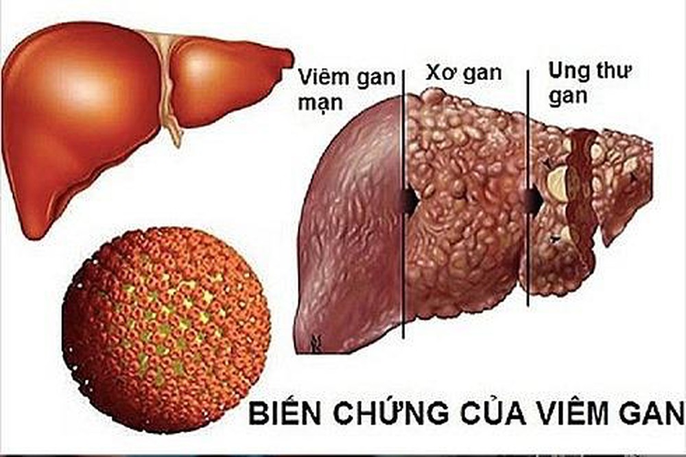 Bác sỹ Bệnh viện K điểm mặt dấu hiệu, nguyên nhân của ung thư gan - 1