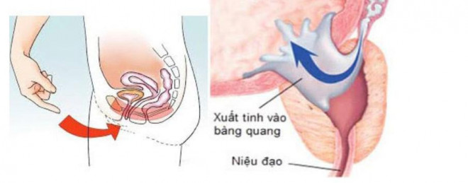 Đái tháo đường là một trong những nguyên nhân dẫn tới tình trạng xuất tinh ngược