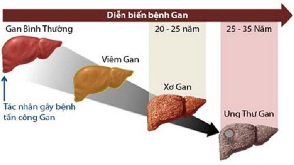 Tiến trình xơ gan do rượu.