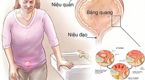 Phụ nữ cần chú ý vệ sinh sinh dục tốt sau khi quan hệ tình dục.