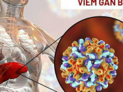 Sức khỏe đời sống - Nhiễm virus viêm gan B sau bao lâu thì xuất hiện triệu chứng và tiến triển thành ung thư gan?