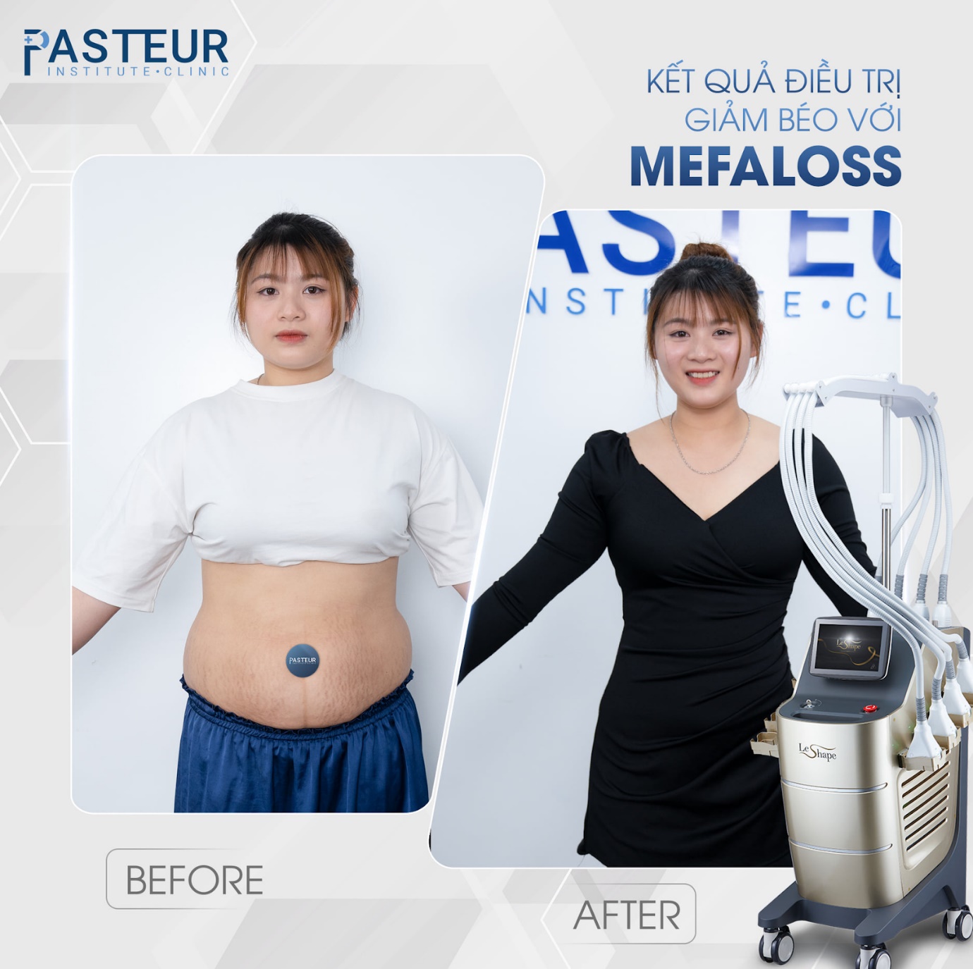 Trải nghiệm công nghệ giảm mỡ hiện đại chuẩn y khoa tại Viện giảm béo Pasteur - 4