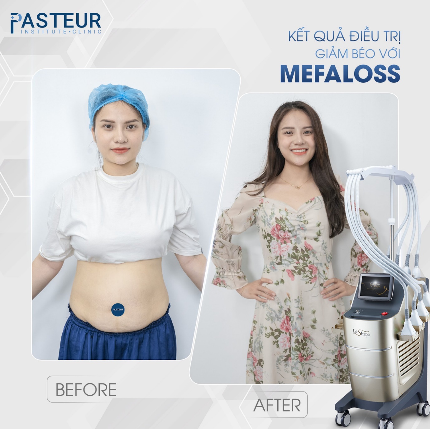 Trải nghiệm công nghệ giảm mỡ hiện đại chuẩn y khoa tại Viện giảm béo Pasteur - 5