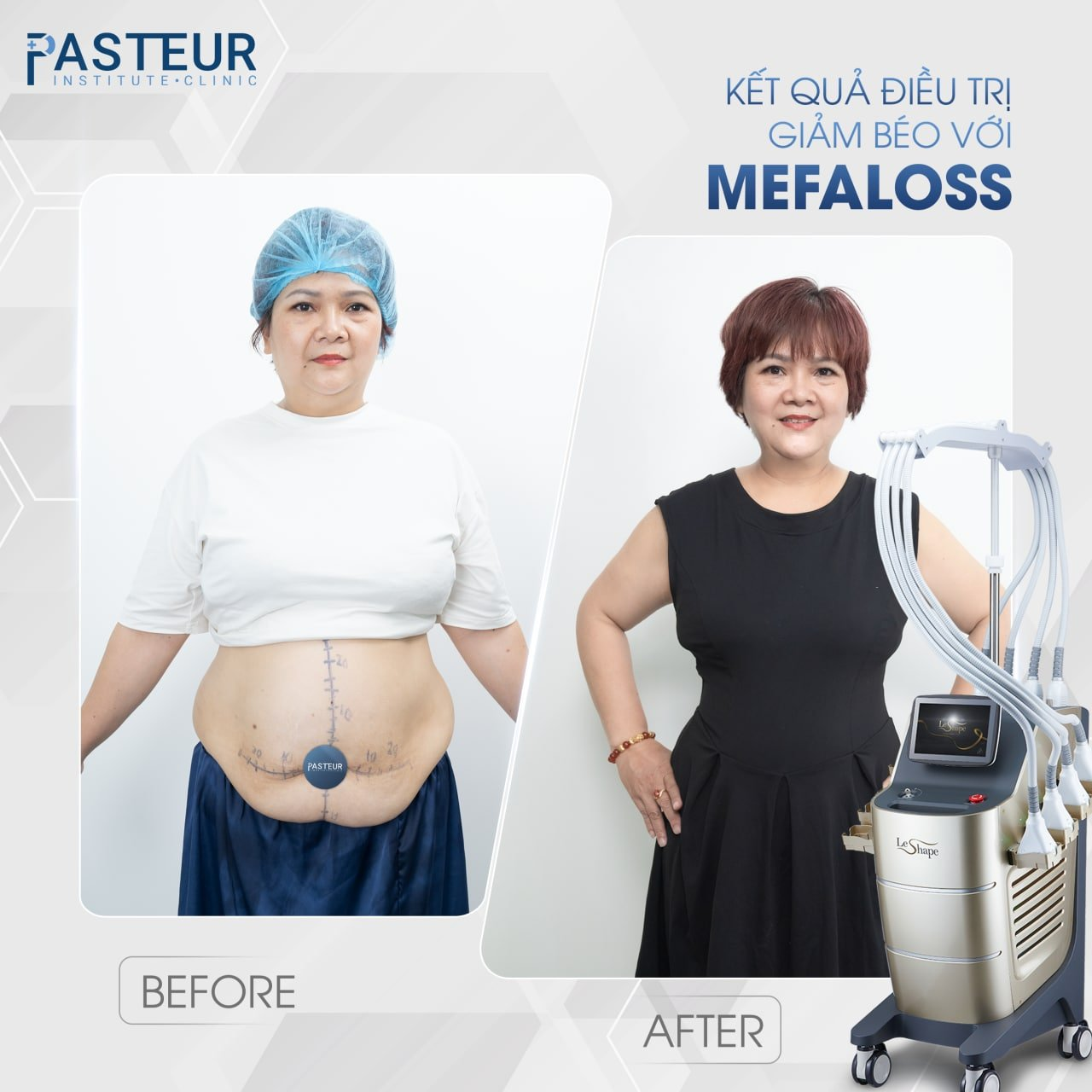 Trải nghiệm công nghệ giảm mỡ hiện đại chuẩn y khoa tại Viện giảm béo Pasteur - 6