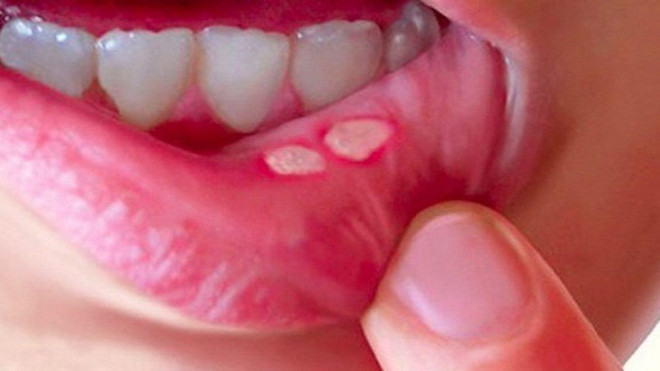 Canker sores and 6 myths to avoid - 2