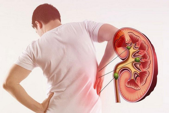 Wrong habits lead to kidney failure - 3