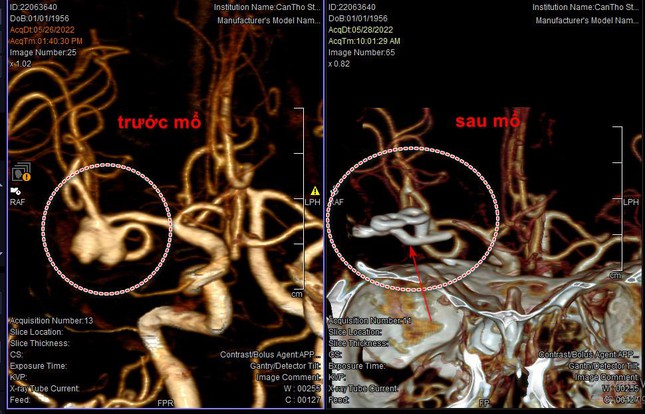 Raise your voice when singing karaoke, "singer"  Cerebral vascular rupture - 1