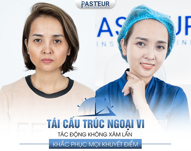 Trẻ hóa khuôn mặt bằng công nghệ tái cấu trúc ngoại vi tại Viện Pasteur có gì đặc biệt? - 2