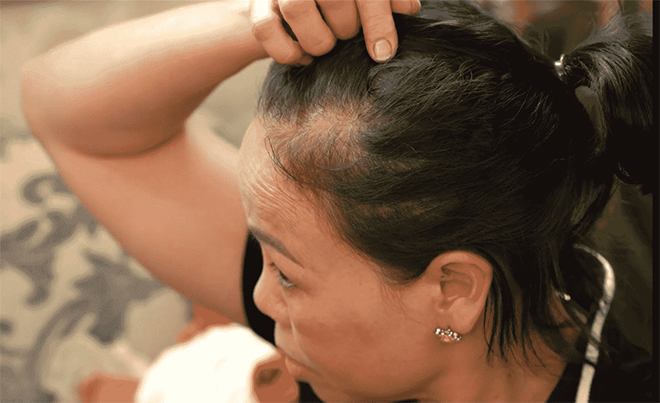 Get rid of hair loss, baldness clinging for 5 years thanks to this way - 2