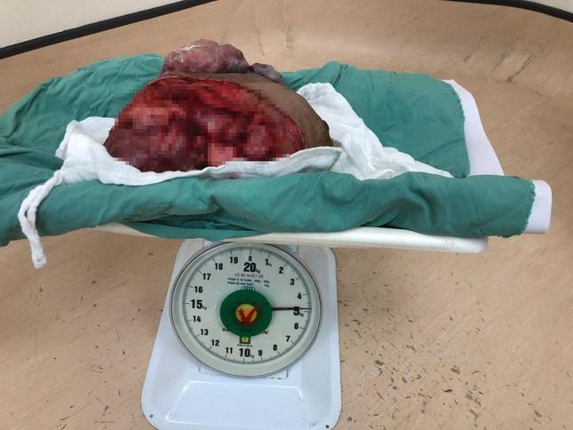 Hơn một năm khối u vú bằng trái chanh phát triển 'siêu tốc' nặng gần 5 kg - 2