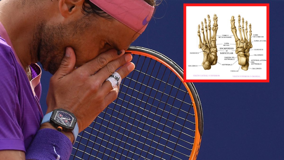 Nadal quyết định mạo hiểm sử dụng phương pháp xung tần số vô tuyến để chữa hội chứng chấn thương bàn chân trái Mueller-Weiss